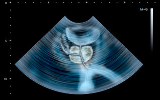 Signs of prostate on ultrasound